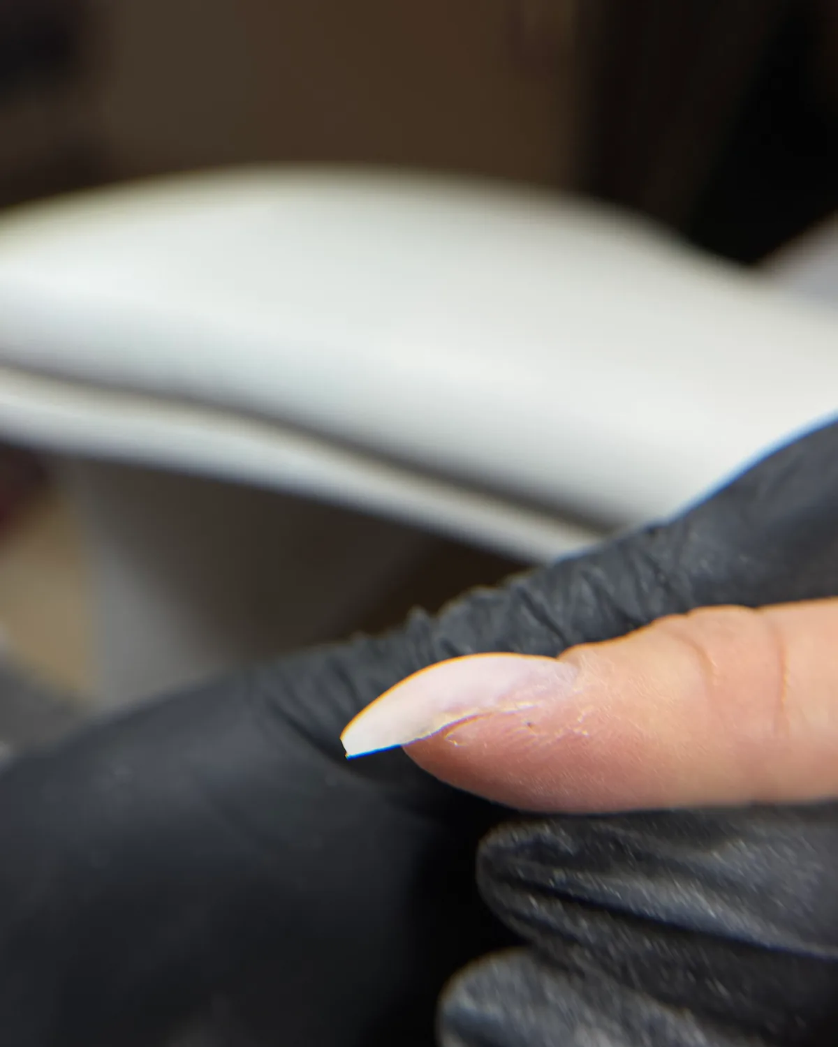 Ongle crochu vu de profil avant correction, la pointe plonge vers le bas