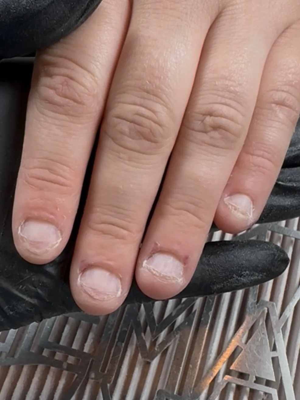 Avant : ongles rongés, courts et abîmés